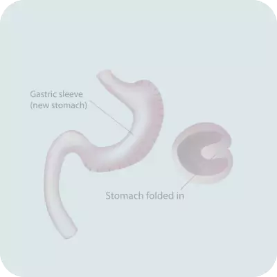 Gastric Sleeve Plication