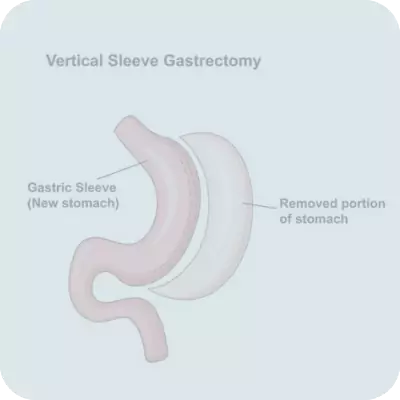 Gastric Sleeve