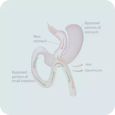 Mini Gastric Bypass