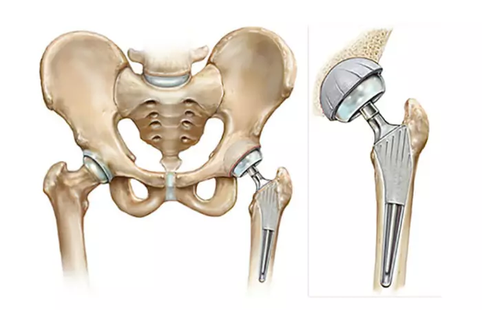 Both Hip Replacement