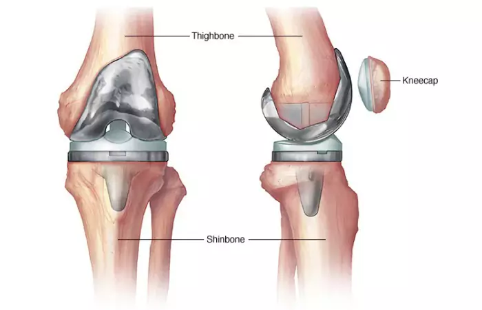 Both Knee Replacement