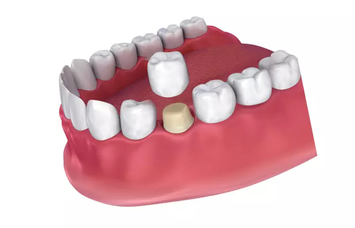 Dental Crowns