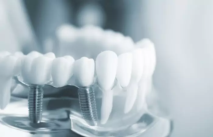 Dental Implants