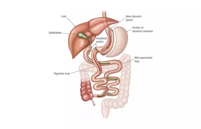 Duodenal Switch