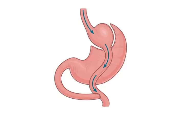 Gastric Bypass