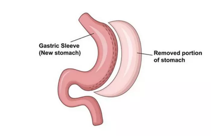 Gastric Sleeve