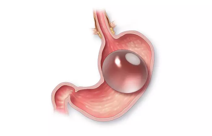 Intra Gastric Ballooning