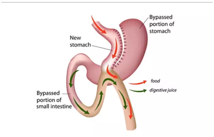 Mini Gastric Bypass