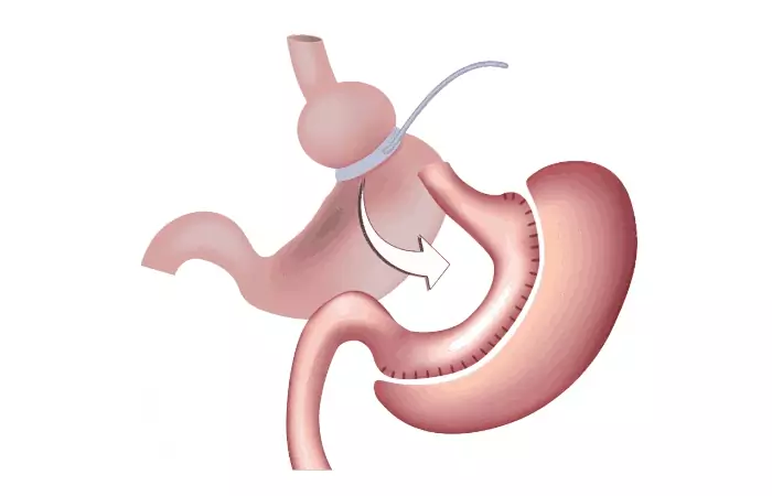 Revision Bariatric Surgery