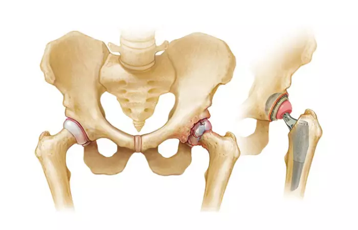 Single Hip Replacement