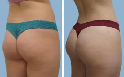Before and After