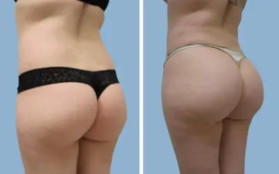 Before and After