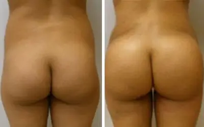 Before and After