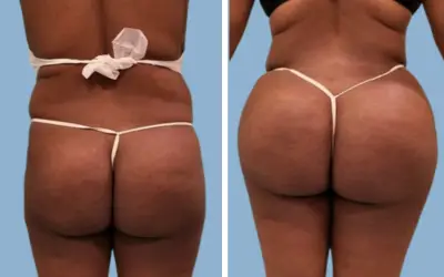 Before and After