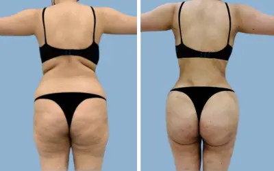 Before and After