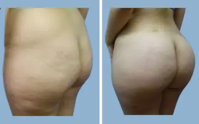 Before and After