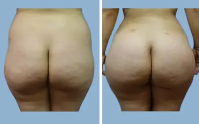 Before and After