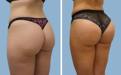 Before and After