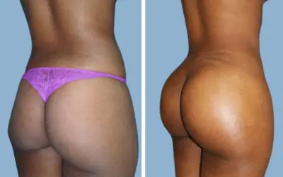 Before and After