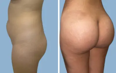 Before and After