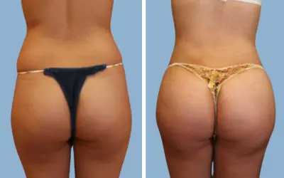 Before and After