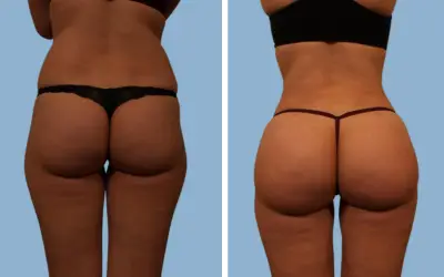 Before and After