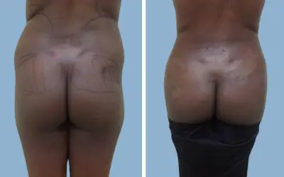 Before and After