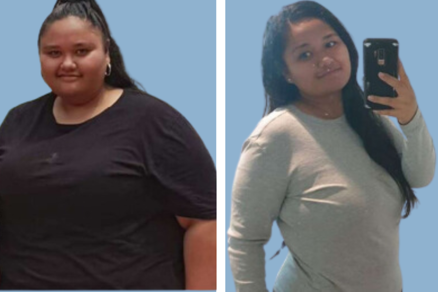 After Bariatric Surgery Pictures | IndiCure Health Tours