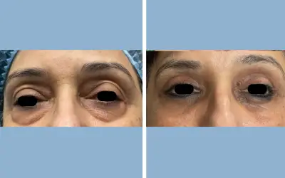Before and After