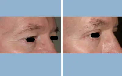 Before and After