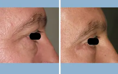 Before and After