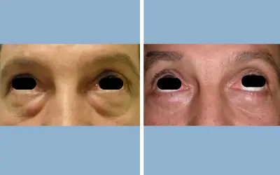 Before and After