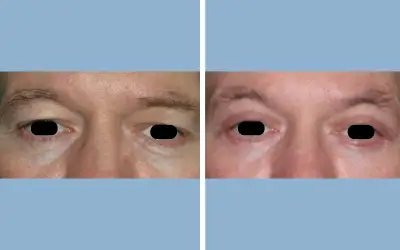 Before and After