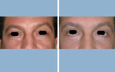 Before and After