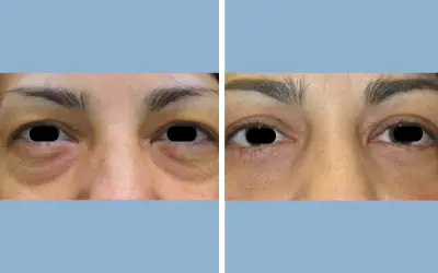 Before and After