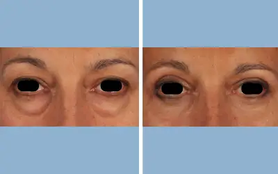 Before and After