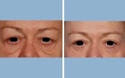 Before and After