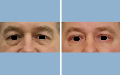 Before and After