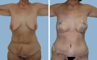 Before and After