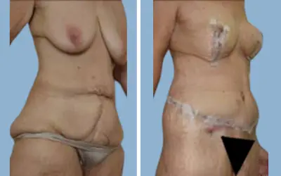 Before and After