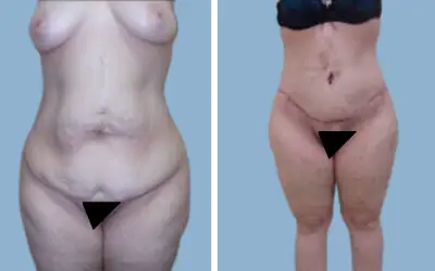 Before and After