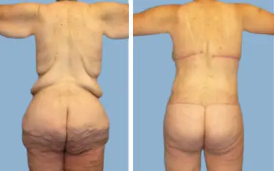 Before and After