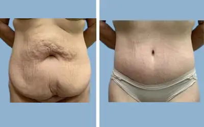 Before and After