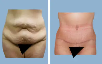 Before and After