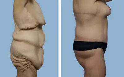 Before and After