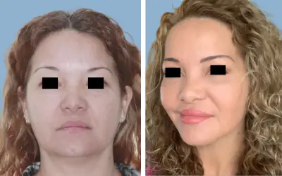 Before and After