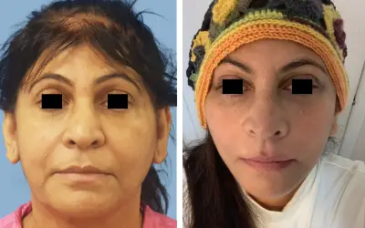 Before and After