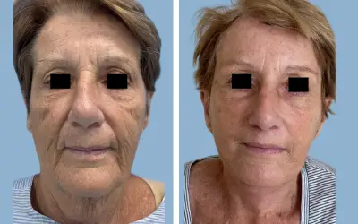 Before and After