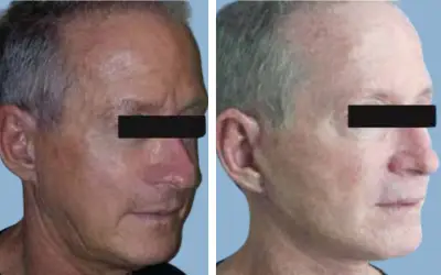 Before and After