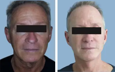 Before and After